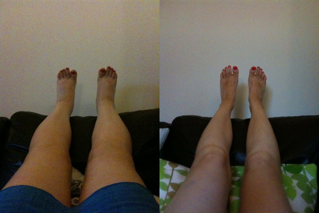 Leg edema - before and after, symptom of minimal change di… | Flickr